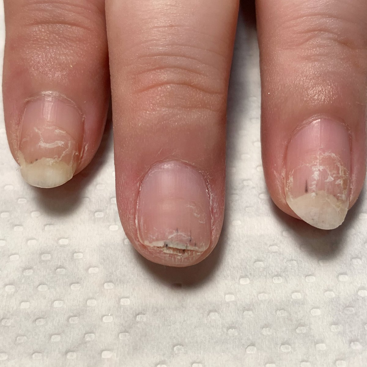 ﾈｲﾙｻﾛﾝｱｳﾛﾗのﾁﾛﾙ 甘皮周りをケアして 今回の状態に合わせた補強をしたいと思います