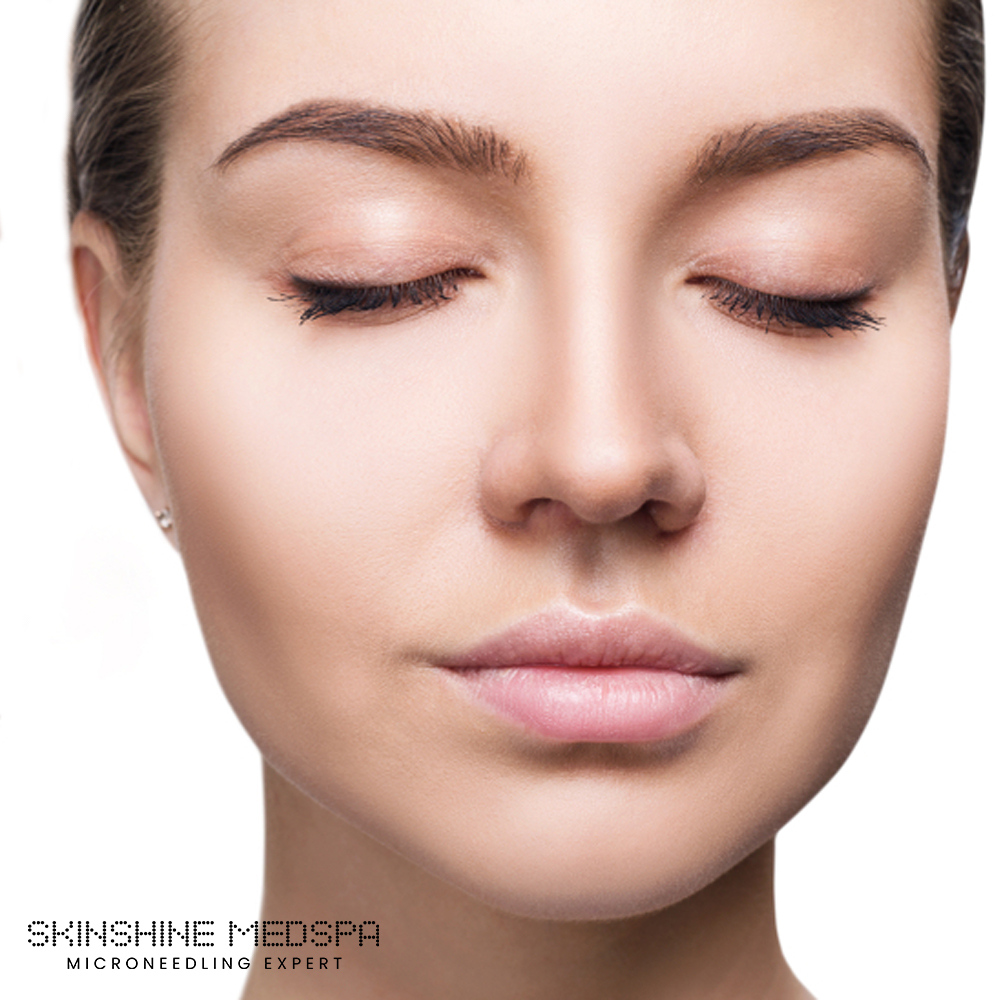 SkinShineMedSpa's tweet photo. Acne occurs when pores get clogged. A part of SkinShine MedSpa’s skin treatment lineup is the Acne + Microneedling Treatment, which uses Benzoyl Peroxide or Alpha Hydroxy acid to remove dead skin and unclog pores. 

#skincare #glowingskin #healthyskin #natural #acne https://t.co/vu7X2oCC3c