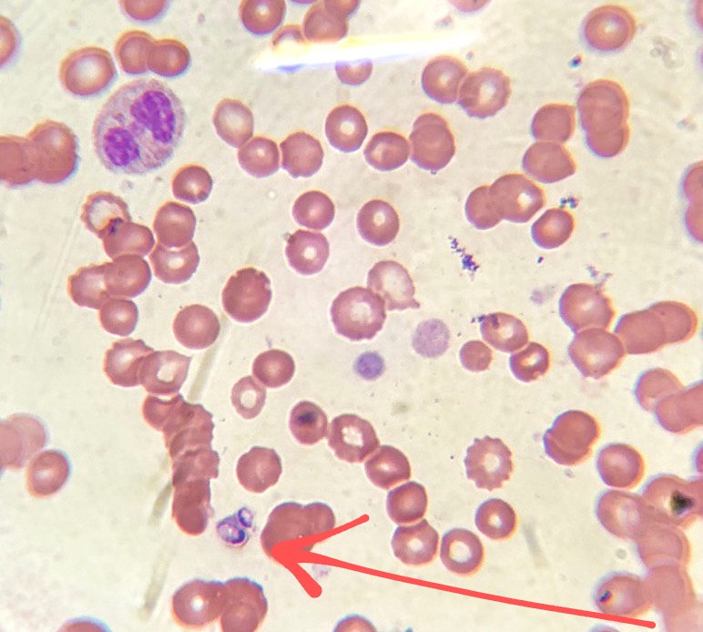 También encontré levaduras de Histoplasma Capsulatum en pacientes COVID, en las primeras imágenes se ven las levaduras en sangre periférica y en la última vemos un neutrófilo que ha fagocitado levaduras de Histoplasma.