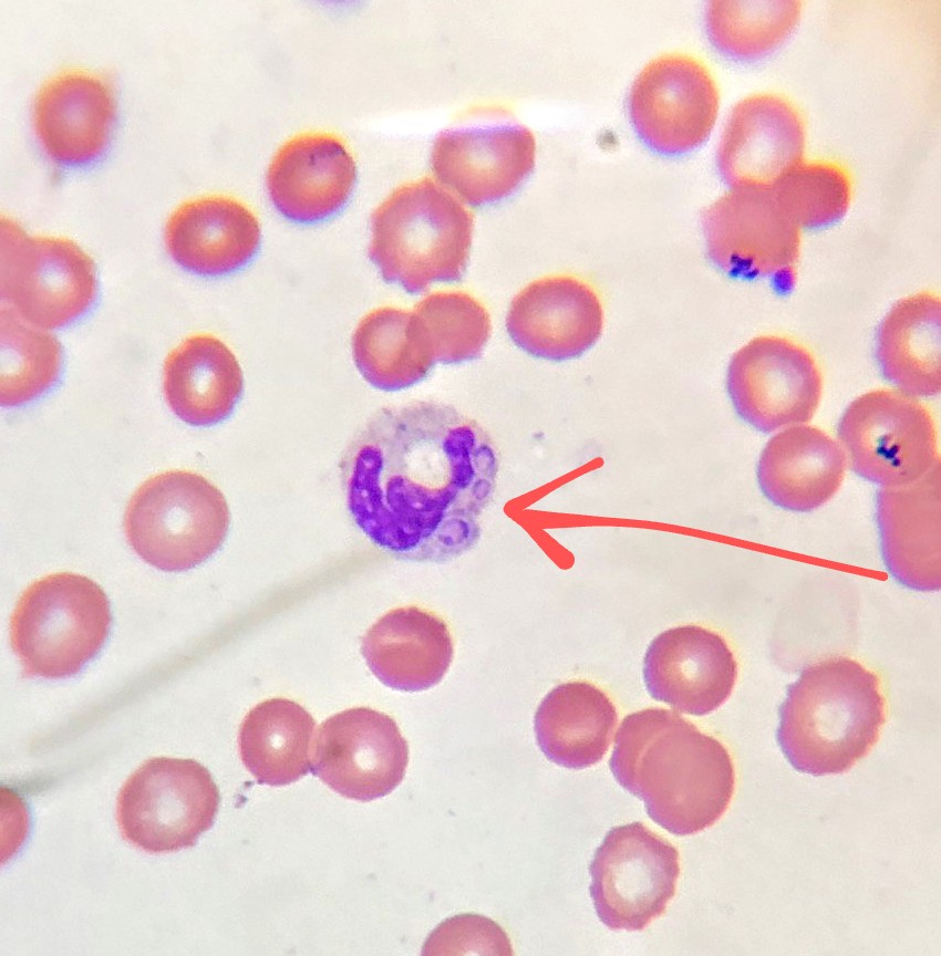 También encontré levaduras de Histoplasma Capsulatum en pacientes COVID, en las primeras imágenes se ven las levaduras en sangre periférica y en la última vemos un neutrófilo que ha fagocitado levaduras de Histoplasma.