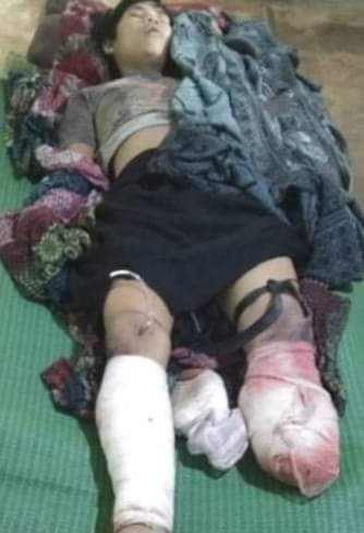 wong_htun's tweet photo. #BreakingNews: One lady, about 17, was injured by landmine near #Tatmadaw security checkpoint in Sangyipaing ward of Kazukaing village, Ann Tsp, Arakan (03-08-2020 = about 7:am) @hrw @YangheeLeeSKKU @Reaproy @ChannelNewsAsia @ABC @AJEnglish @KenRoth @FortifyRights @UN @BBCWorld https://t.co/wkAJSXgZK2