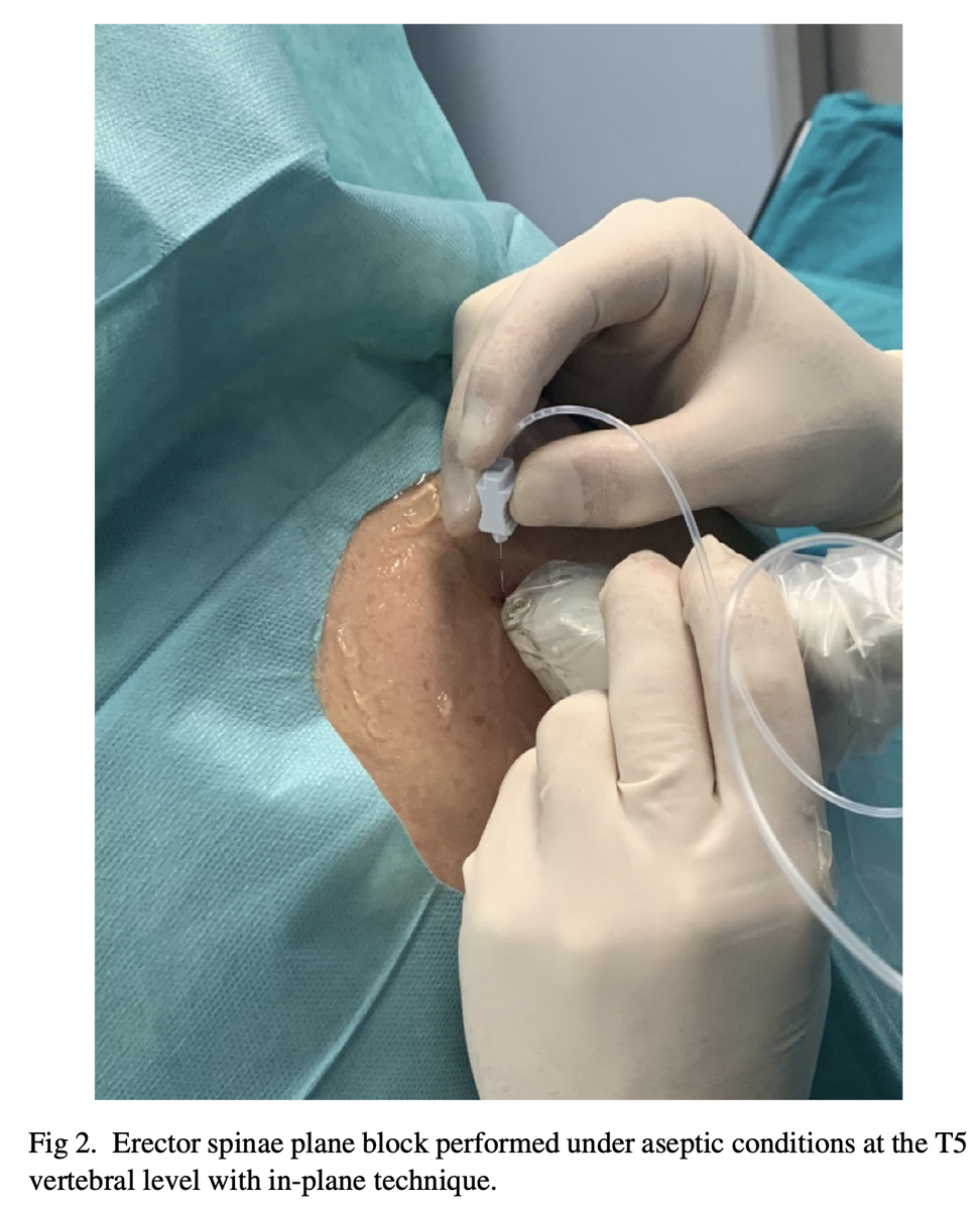 Erector Spinae Plane Block provided superior analgesia, lower perioperative analgesic requirements, better patient satisfaction, and less respiratory muscle strength impairment than intercostal nerve block in minithoracotomy. #nerveblocks #pocus
jcvaonline.com/article/S1053-…