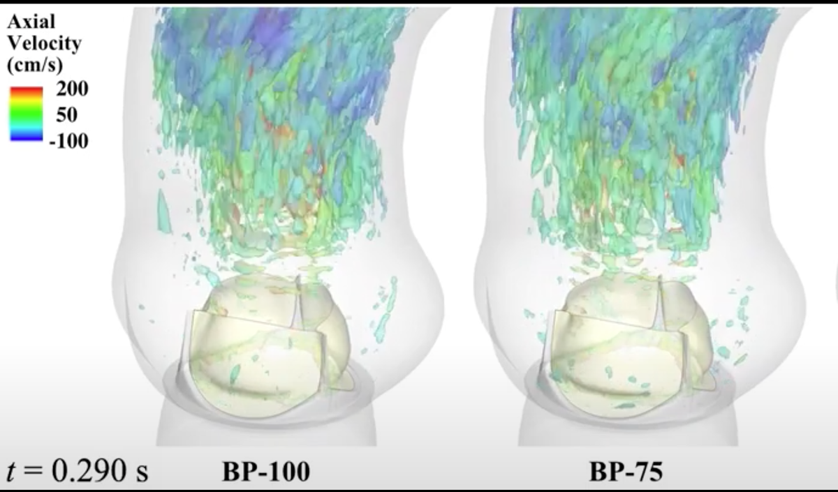 Computational modeling techniques enable visualizations of heart valve behavior. Simulations by lead author Emily L. Johnson @IowaStateU @IowaStateUNews 
@UTAustin #OdenInstitute Powered by @TACC #computationalmedicine #computationalmodeling #HPC
bit.ly/39YSeAc