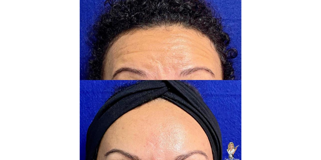 SplitRockAesIns's tweet photo. 😎 She’s loving her Dysport forehead lines smoothness! Before and after, two weeks results.
•
Contact us for a complimentary consultation!
◽️Split Rock Aesthetic Institute
◽️Phone: (203) 831-8029
◽️Email: info@lisatopham.com
◽️Website: https://t.co/05Owc9YoNB https://t.co/APLoInfcP7