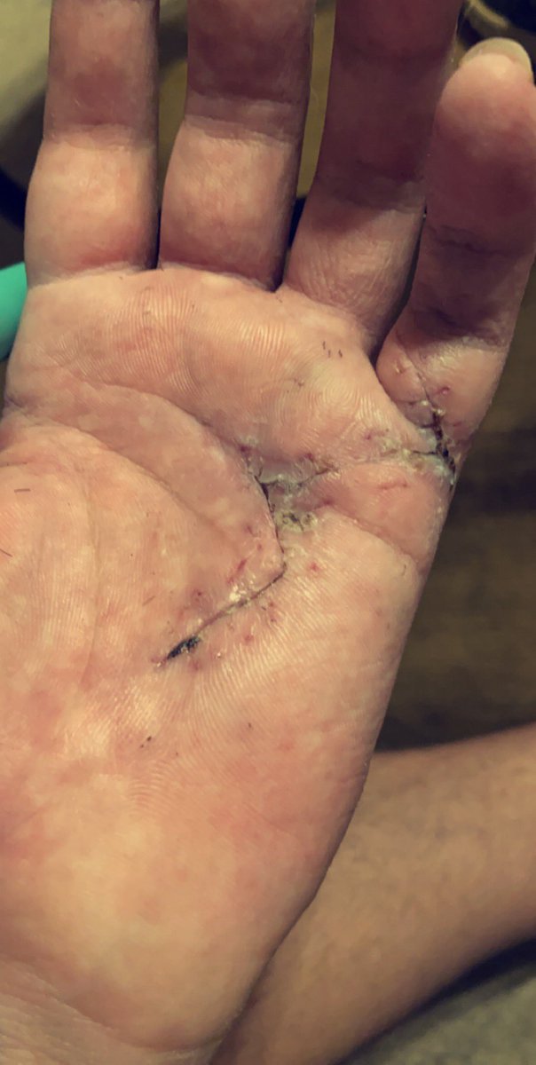 tjmoraniec's tweet photo. I know it looks gross but I got my staples out (video to come) &amp; a fresh cut.🙏🏼✂️ #solidmonday https://t.co/3ZBSvkWbaB