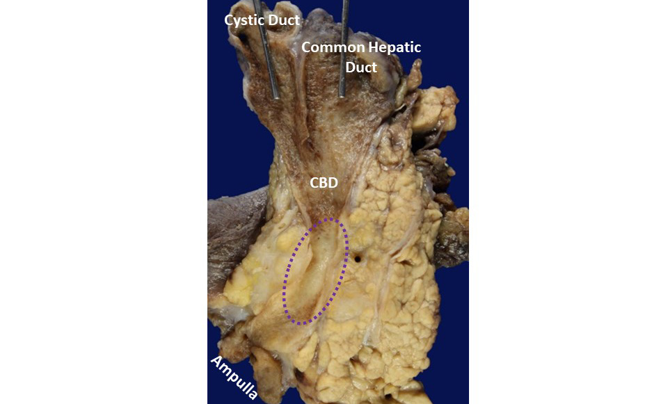 OlcaBasturk's tweet photo. Low-union (cystic duct joining the common hepatic duct inside of the pancreas) appears to be associated with #pancreas, #distalbileduct & #ampulla carcinomas. A recent study reports that low-union, seen in <10% of the population, is present in 44% of these carcinomas. https://t.co/cUUJmruuOC