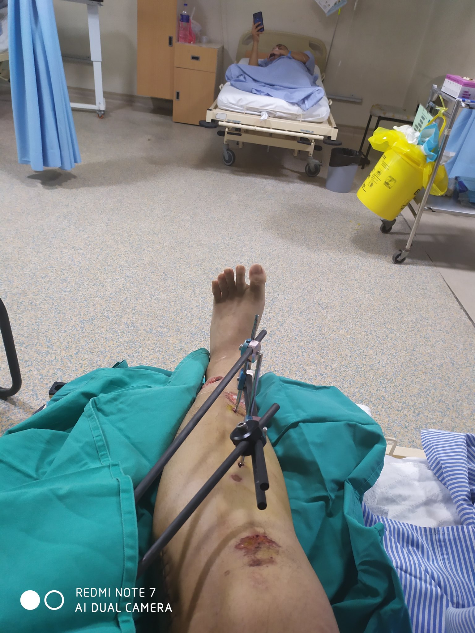 Nidduzzi Auf Twitter 15 8 2019 Aku Accident Motor Patah Tangan Dan Kaki Tangan Masuk Besi Kaki Sampai Sekarang In Recovery Jentera Aku Kondisi Baik Pengalaman Ride 10 Tahun Tapi Itulah Kita Menanggung
