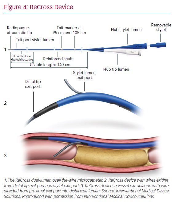 HanCardiomd's tweet image. This is one of the nice review paper on CTO in @radcliffeCARDIO . icrjournal.com/articles/anteg… Antegrade Chronic Total Occlusion Strategies: A Technical Focus For 2020 @mmamas1973 @DrSarahClarke @EAPCIPresident @PCRonline @EuroInterventio @ESC_Journals @yaqoub_lina @mirvatalasnag