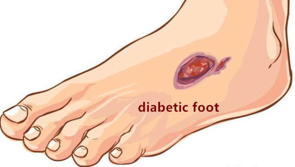 ctod_editor's tweet photo. #CTOD Consistency of microbiological and pathological tests between infected bone and surrounding deep soft tissues in diabetic foot osteomyelitis: study protocol for a single-center, self-controlled, open-label trial
#diabeticfoot #osteomyelitis 

https://t.co/bQ7jJb4YKO https://t.co/mzj4SyT1u7
