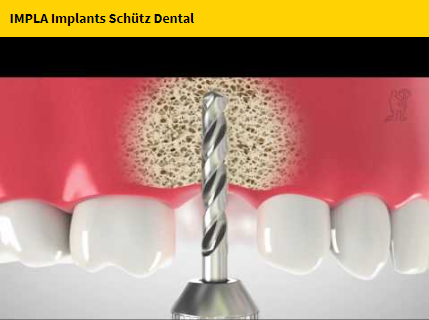SchuetzDental's tweet photo. #IMPLA implants ⚙️over 50 years of experience for more #safety and #reliability . https://t.co/ngwf3Qo4s6 
#schützdental #dentaltechnology https://t.co/qqCECjoKJI