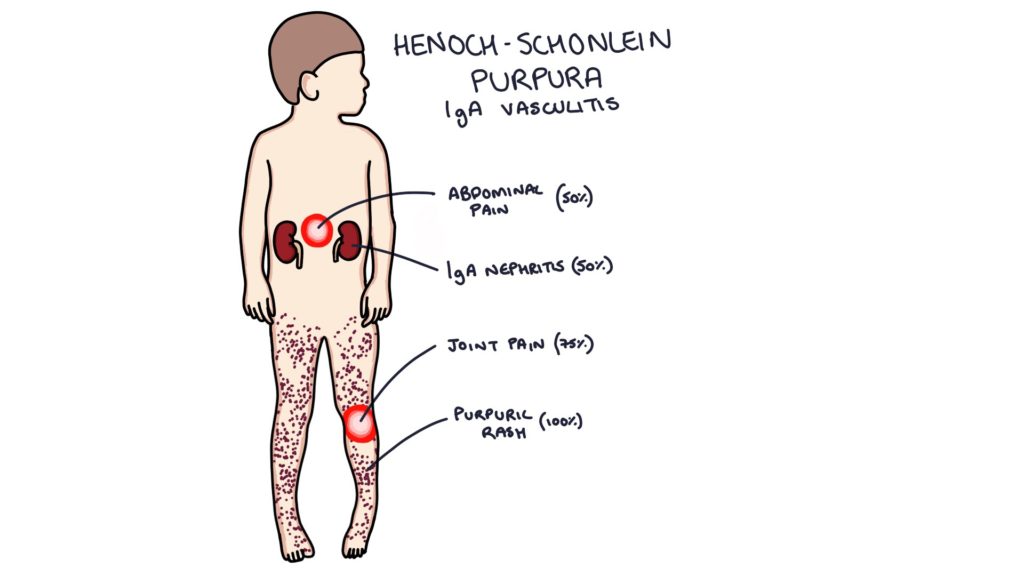 ata2at's tweet photo. Henoch-Schonlein purpura
#HSP or we just can say vasculitis ! 
ايش هذا المرض وهل هو مشابه لالتهاب الاوعية الدموية 
تعالو نتعرف عليه 

#nursing_intern #Nursing #التمريض #التمريضـالسعودي https://t.co/l08DKBCzzr