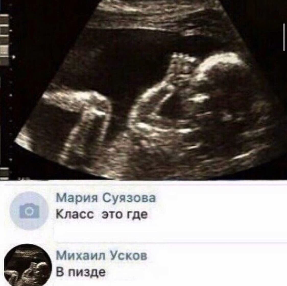 Резус конфликт при беременности УЗИ