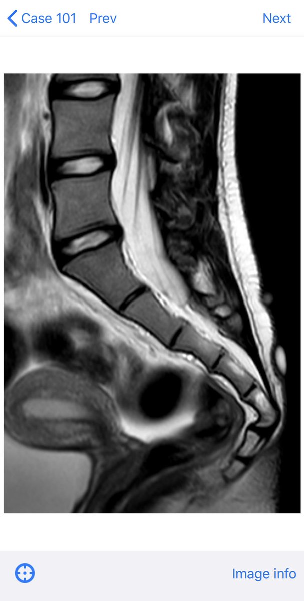 BoSTT_app's tweet photo. Have a look at Case 101 on BoSTT app! Nice bone tumour case with path-rad correlation.
#BSTpath #MSKRad #pathology #radiology #FOAMed #FOAMrad #bonetumor https://t.co/kGGpVjxnBG