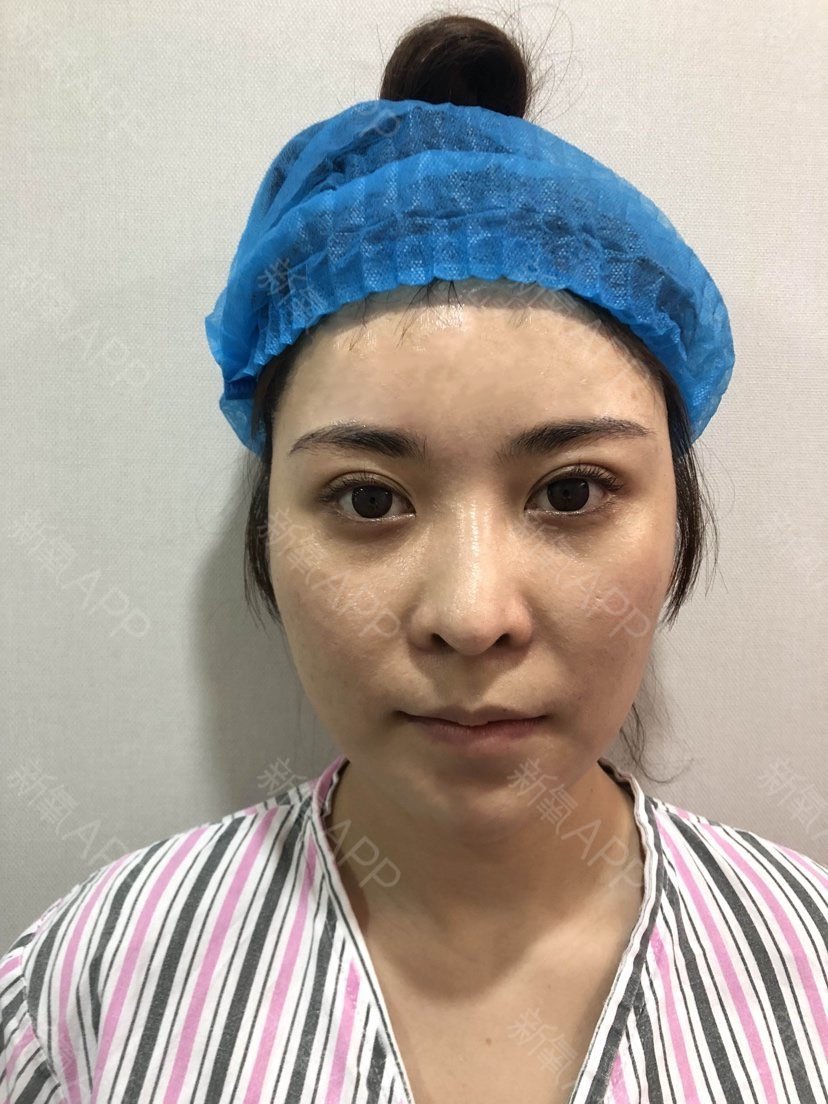 meirong3333's tweet photo. 施術名:小鼻縮小術+幅が��い小鼻を狭くする手術を行いました

❤️小鼻縮小の傷跡は、鼻の��け根の部分になり、もともと赤みを帯びている部分なため、ほとんど気になりません🌟

#美容垢さんと繋がりたい #整形垢さんと繋がりたい https://t.co/t9IEM1OsLn