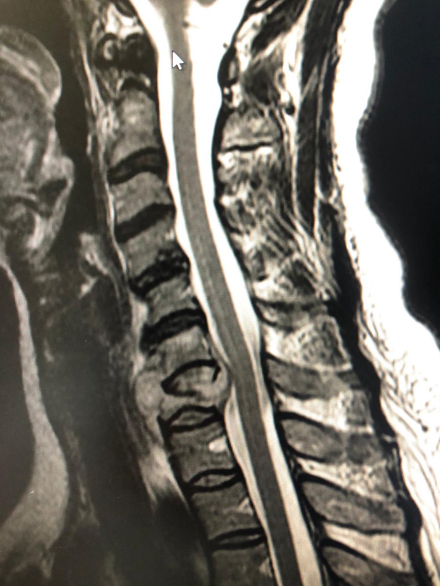 medcomtech_sa's tweet photo. Paciente operado esta mañana en Hospital de Son Llatzer por el Dr.Toribio y el Dr. March. 45 años,metástasis en C7, corporectomia C7, se coloca malla MESH de Biedermann más placa anterior. @cot_hsll @medcomtech_sa #cirugiadecolumna @Biedermann100 #siempreconlosmedicos https://t.co/AxwQOfDD6T