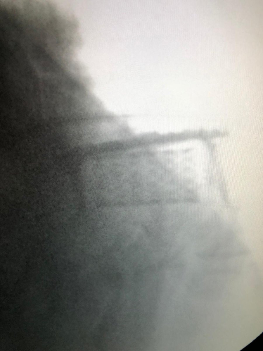 medcomtech_sa's tweet photo. Paciente operado esta mañana en Hospital de Son Llatzer por el Dr.Toribio y el Dr. March. 45 años,metástasis en C7, corporectomia C7, se coloca malla MESH de Biedermann más placa anterior. @cot_hsll @medcomtech_sa #cirugiadecolumna @Biedermann100 #siempreconlosmedicos https://t.co/AxwQOfDD6T