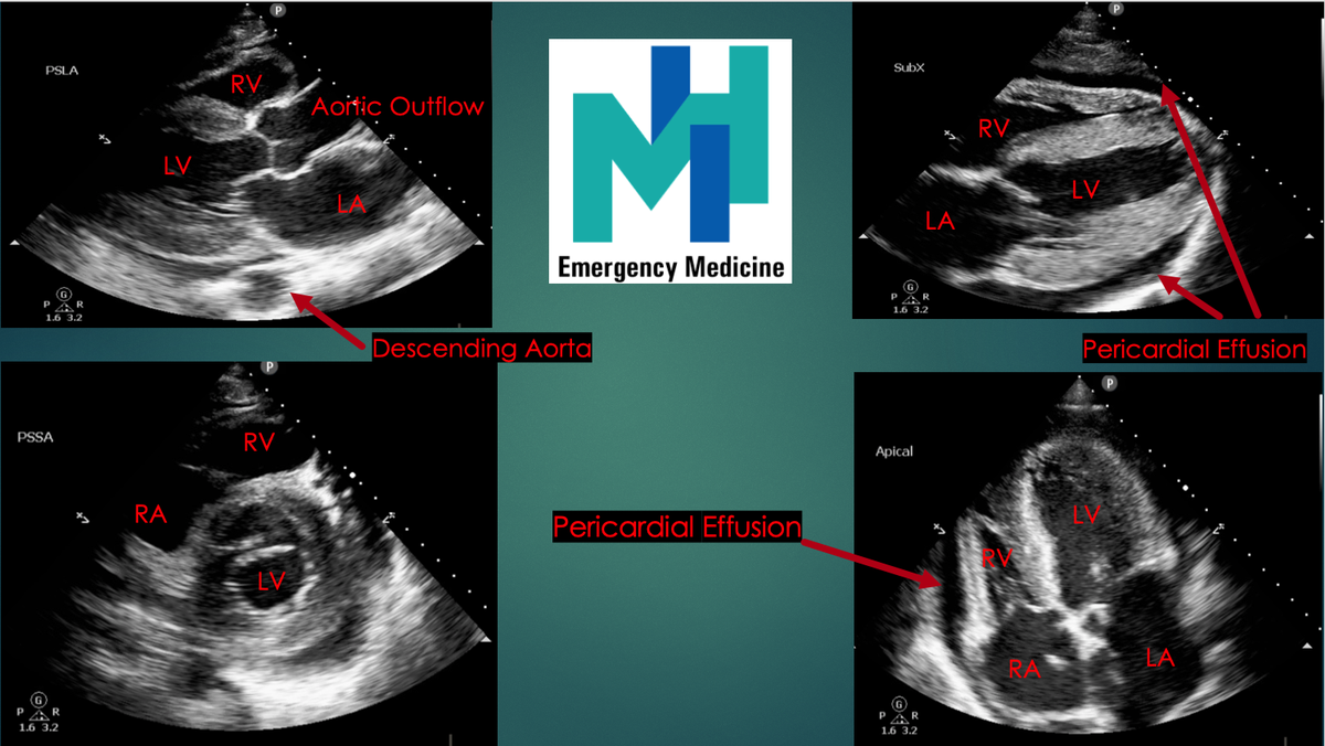 Great labeled Point of Care ECHO performed by one of our residents with a chronic pericardial effusion. #POCUS #FOAMus #FOAMed #MedEd #MedTwitter #EmergencyMedicine #MedStudentTwitter