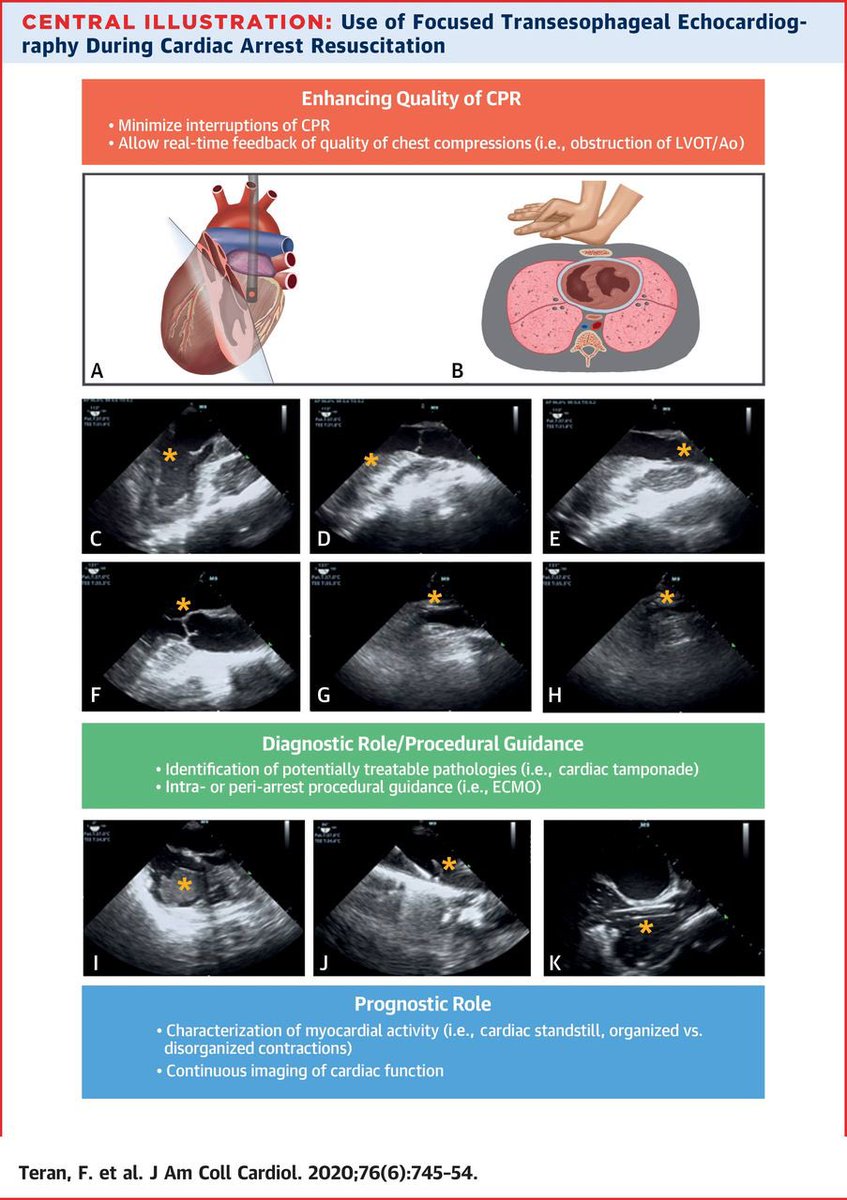 Bret Nelson (@bretpnelson) on Twitter photo Is transesophageal echo useful in cardiac arrest? How is it performed? Can we summarize the concept in a picture?
Check out <a href="/JACCJournals/">JACC Journals</a> for our manuscript!
onlinejacc.org/content/76/6/7…
<a href="/FTeranMD/">Felipe Teran, MD MSCE</a> <a href="/PratsEM/">Michael I. Prats</a> <a href="/dpbahner/">david bahner</a> <a href="/arntfield/">Robert Arntfield</a> <a href="/SashaShillcutt/">Sasha Shillcutt MD</a> <a href="/rosskess/">Ross Kessler</a> Is transesophageal echo useful in cardiac arrest? How is it performed? Can we summarize the concept in a picture?
Check out <a href="/JACCJournals/">JACC Journals</a> for our manuscript!
onlinejacc.org/content/76/6/7…
<a href="/FTeranMD/">Felipe Teran, MD MSCE</a> <a href="/PratsEM/">Michael I. Prats</a> <a href="/dpbahner/">david bahner</a> <a href="/arntfield/">Robert Arntfield</a> <a href="/SashaShillcutt/">Sasha Shillcutt MD</a> <a href="/rosskess/">Ross Kessler</a>