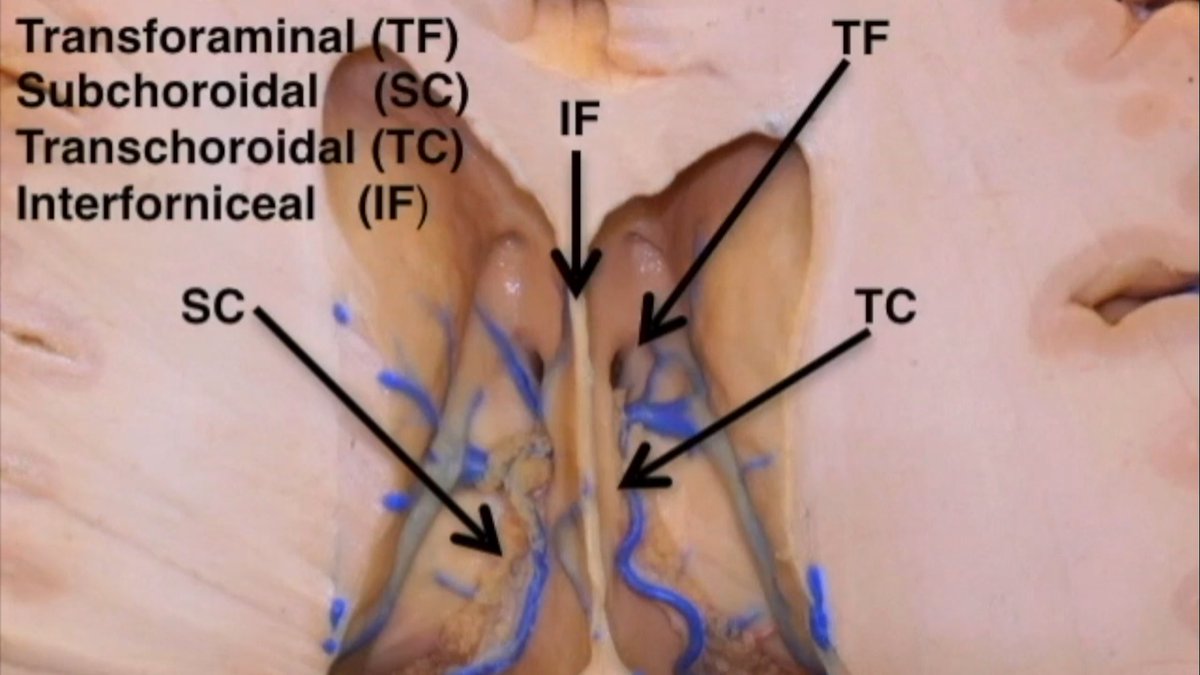 DrBaskaya's tweet photo. Ant. #interhemispheric transchoroidal #approach provides a safe corridor for resection of #thalamic #gliomas & gross total/radical subtotal resection is possible in most of cases @NeurosurgeryCNS
https://t.co/wE9510WHRe
Video:
https://t.co/fr993wY4BY
#nsgy #neuroonc #Neurosurgery https://t.co/4qJZXNjtE0
