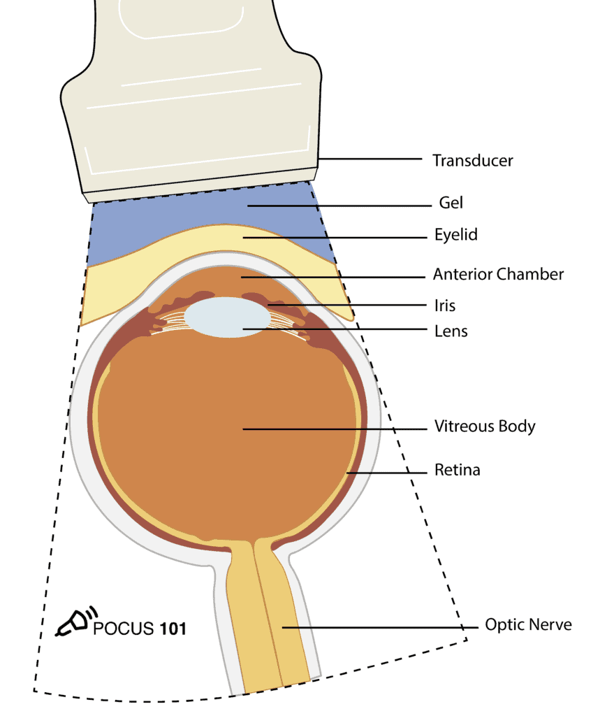 POCUS 101 on Twitter: "(9) There are three types of Retinal Detachments:  Rhegmatogenous, Traction, and Exudative. 👉🔗https://t.co/s3KYXoEuKM  https://t.co/3UCrNOj1oV" / Twitter