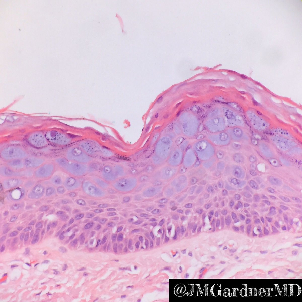 JMGardnerMD's tweet photo. Lovely blue-gray cytoplasm in keratinocytes is from HPV. Classic epidermodysplasia verruciformis, a form of flat wart. more info in my #dermpath #pathsurvivalguide book: https://t.co/85dyJi37nn #Pathology #dermatology https://t.co/pXf6dL6TaB