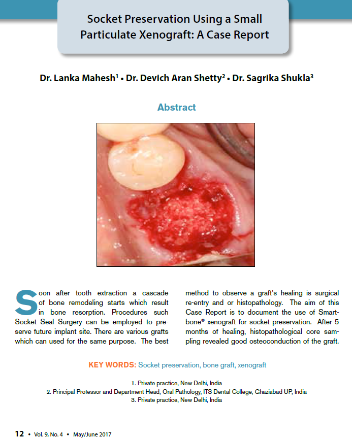 smartboneibi's tweet image. No matter where you’re from nor which technique you apply, you can safely use SmartBone® in socket preservation‼️

➡️Read the publication: buff.ly/33kDn1D

#socketpreservation #dental #surgery