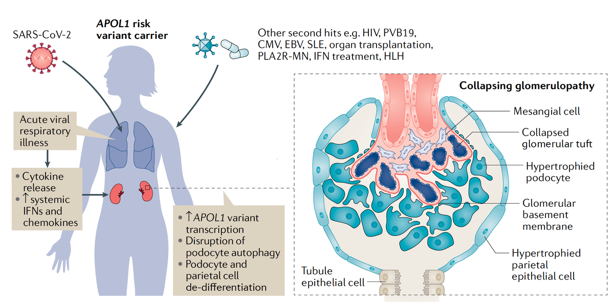 EricTopol's tweet image. A serious kidney condition known as collapsing glomerulopathy has reemerged with #COVID19. The risk for it is tied to an APOL1 gene variant, one or 2 copies occur in 14% of people of African ancestry, in whom all of the cases have been reported to date nature.com/articles/s4158…
