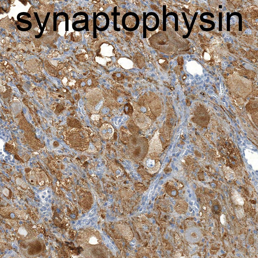 CraigHorbinski's tweet photo. Desmoplastic infantile ganglioglioma, WHO grade 1. Those are some really big ganglion cells!
#pathology #pathtwitter #neuropath #pediatrics https://t.co/PWDtkI1mFs