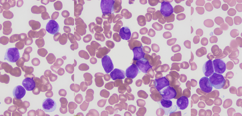 One of those leukemias that read the books.. a perfect example of Cup-like blasts... flow phenotype was CD34-, CD117+, HLA-DR- , which often raises concern for APL... This is a classic example of NPM1-mutated AML..  #hemepath #leusm 

pubmed.ncbi.nlm.nih.gov/19672946/