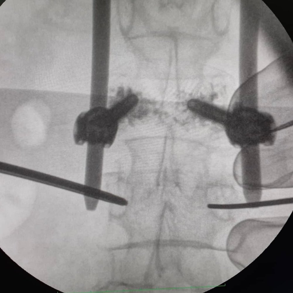 Invimedic's tweet photo. Cifoplastia con balón
👨🏻⚕️Dr. Luis Moreira
👨🏻⚕️Dr. Diego Campoverse
🏨 Hospital Luis Vernaza
.
.
#HLV #columna #cifo #cifoplastia #Invimedic #spine https://t.co/FQisRnUlSQ