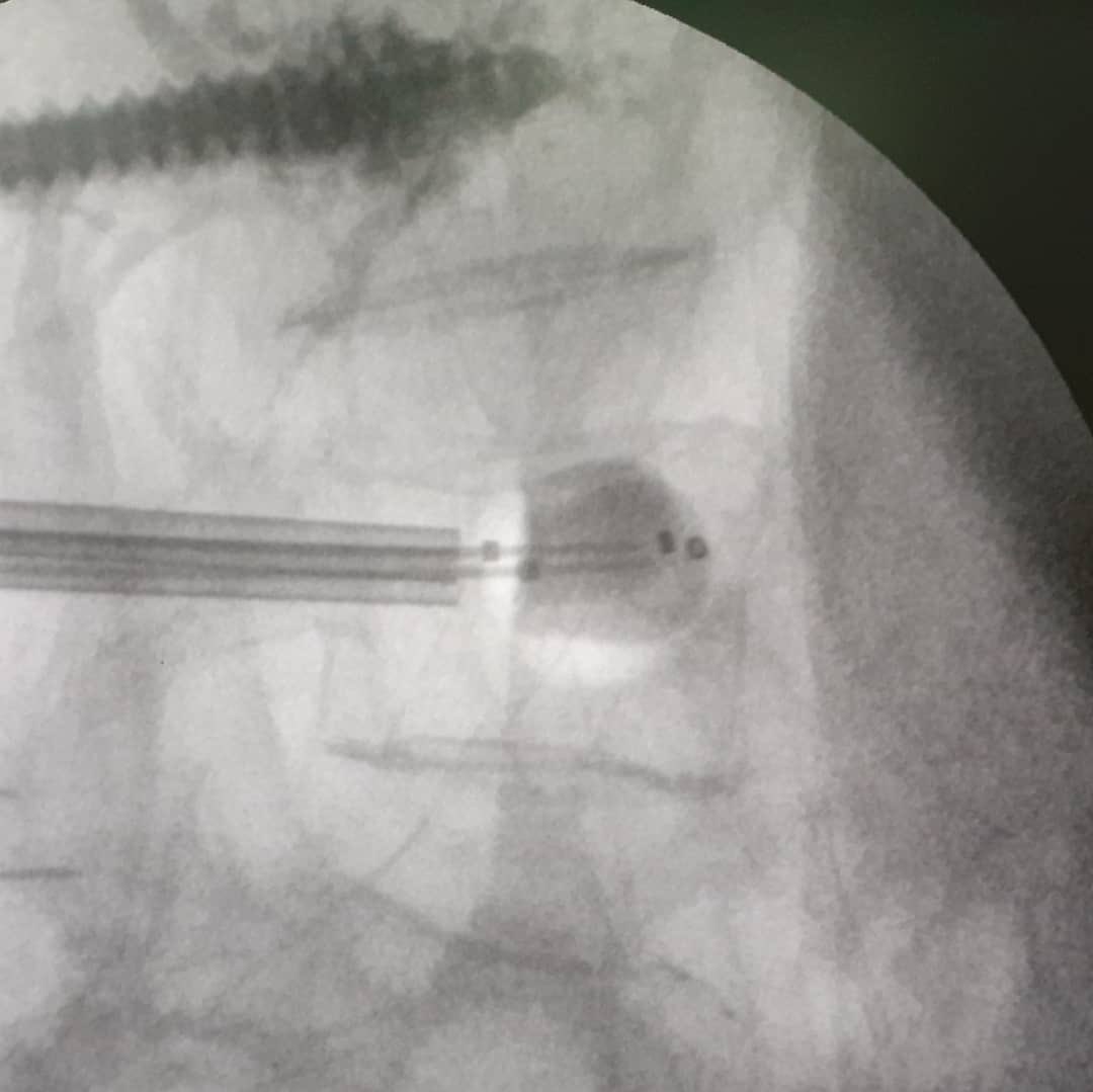Invimedic's tweet photo. Cifoplastia con balón
👨🏻⚕️Dr. Luis Moreira
👨🏻⚕️Dr. Diego Campoverse
🏨 Hospital Luis Vernaza
.
.
#HLV #columna #cifo #cifoplastia #Invimedic #spine https://t.co/FQisRnUlSQ
