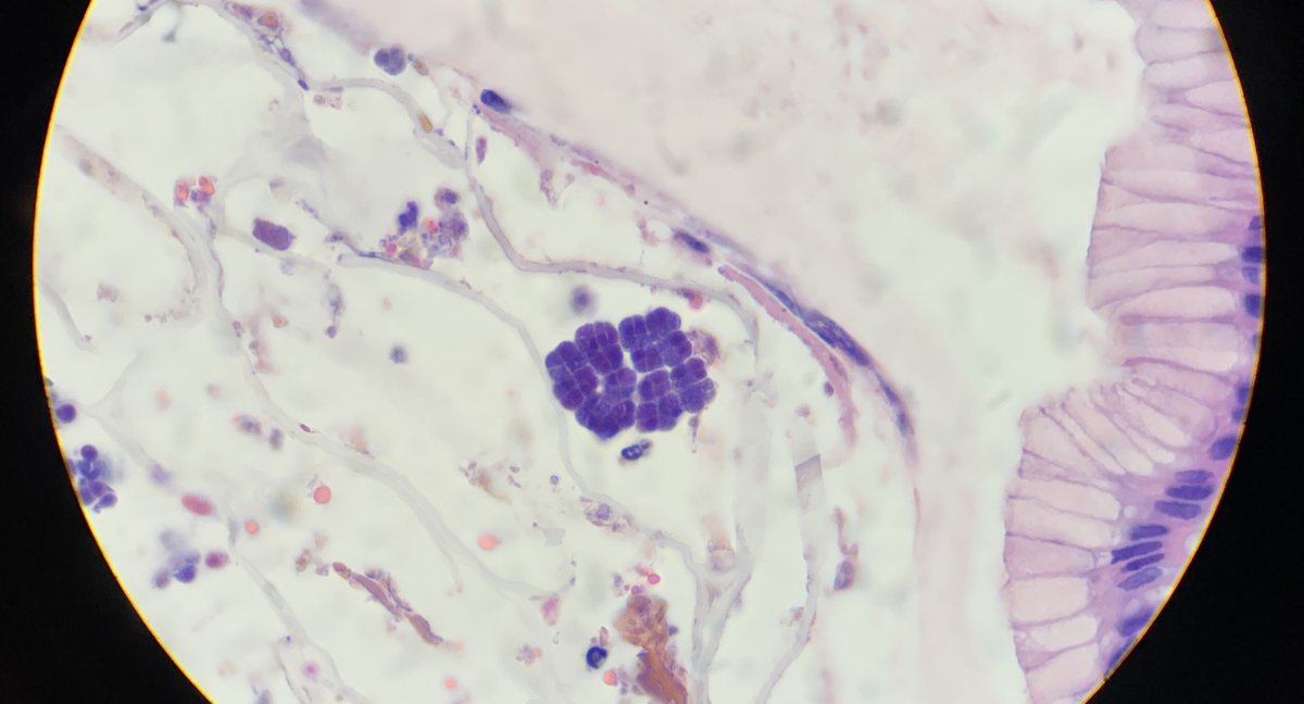 Gastric biopsy (H&amp;E 1000x) reveals cuboid "packets" of microbes. This organism has been associated with delayed gastric emptying, produces cellulose, and is an obligate anaerobic gram positive bacterium that is not recovered in routine culture. 𝘚𝘢𝘳𝘤𝘪𝘯𝘢 𝘷𝘦𝘯𝘵𝘳𝘪𝘤𝘶𝘭𝘪