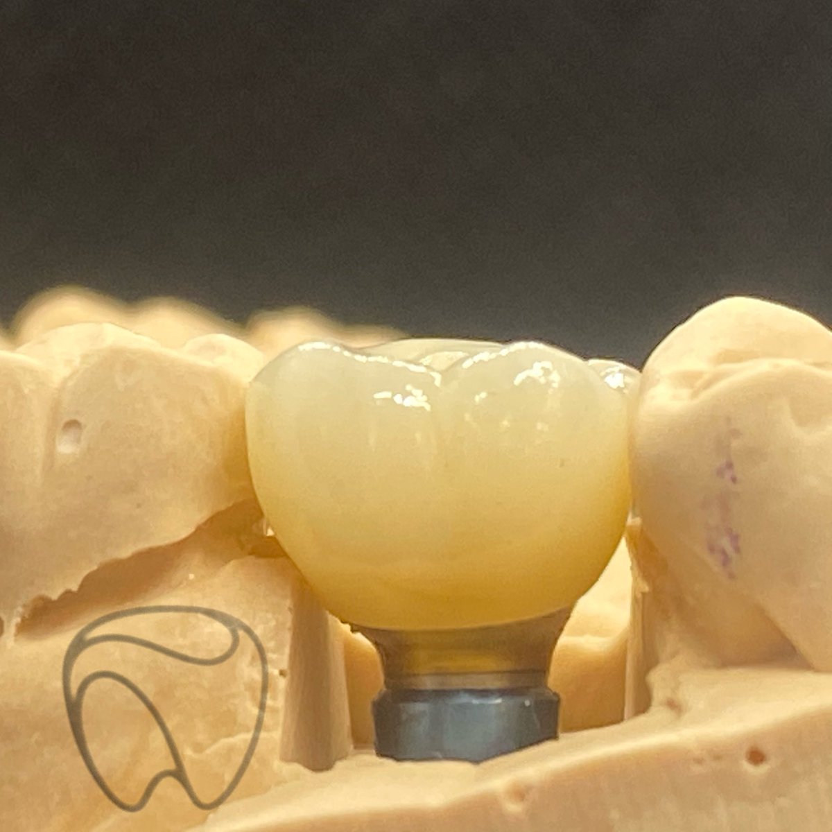 LabExcellence's tweet photo. The Atlantis CustomBase solution is a patient-specific prosthetic component giving us more control of the emergence profile and gingival height. This gives optimal support for soft-tissue sculpturing and adaptation to the finished crown.  

#implantdentistry #dental #Dentsply https://t.co/hRUbqdZIq9