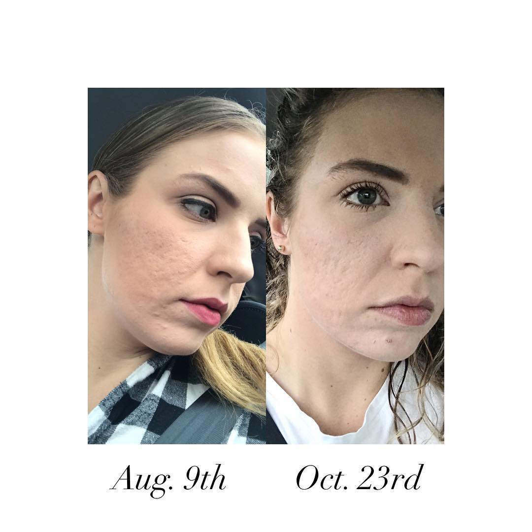 Do you have acne scarring like @confessionsofskin? Check out her recommendations that help her skin with this: Products I’ve been using for scarring: instagram.com/p/CDezUiwBlzu/