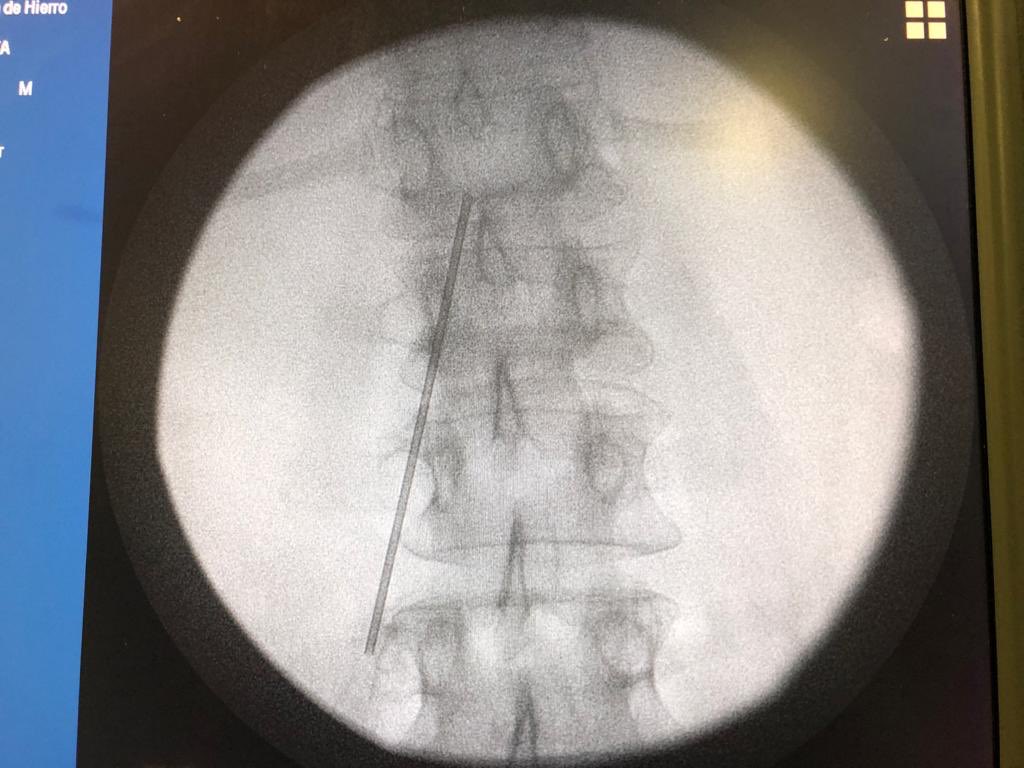 herrero_dr's tweet photo. Excellent Epidural Neuroplasty kit #chronicpain #neuroplasty #adhesiolysis #painmanagement #painblock @stimhealth #axon https://t.co/MAsIudpEkf
