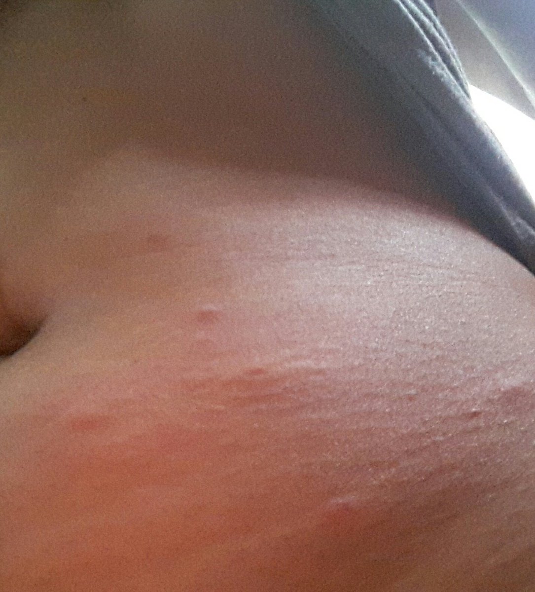 Bebechii's tweet photo. Tengo piquetes detrás de las rodillas, ingles, abdomen, donde va el bra, hasta en las axilas. 
Al menos sirvo de alimento.
Al menos algo me pica.
Al menos ok ya.
#putosmoscos o serán pulgas o chinches? Échenme el caladryl! https://t.co/IN0L8j4PxF