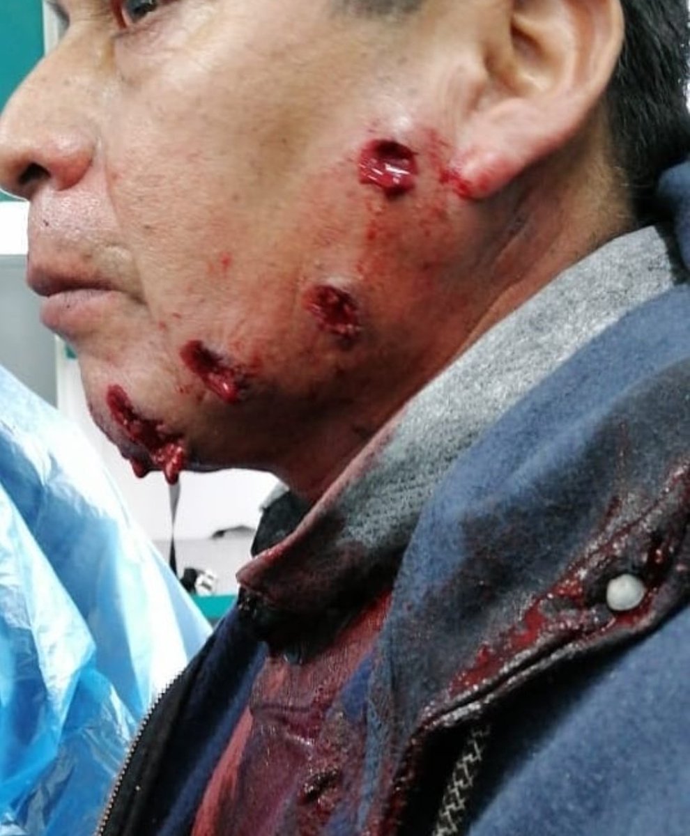 PiensaPrensa's tweet photo. CHILE | Wallmapu: Longko Juan Nahuelpi del Lof Liukura de Lumako. Carabinero disparó DIRECTO AL ROSTRO y a quema ropa (hoy) 
Que el mundo conozca que en Chile se asesina al mapuche.

#RenunciaPerez https://t.co/YZXnnrrmDj