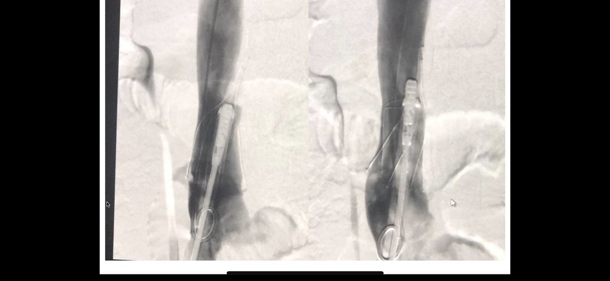 Mike_Roark's tweet photo. Thoroughly enjoyed learning from the best when it comes to filter retrievals @rkryu @kush_r_desai @JonnyMoriarty #gtfo #OptionElite can bend if needed unlike some others 🤯🤯 https://t.co/AybfCaXKWy