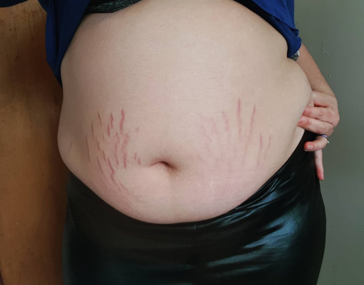 dangerz0nne's tweet photo. Stretch marks and leather. 🖤 Why not check me out more personally on #JFF?  

#fatbelly #fatsw #chubbygirls #buymynudes #stretchmarks #leather #queersw #justforfans #onlyfans #sellingnudes https://t.co/wpEiCSa7Lk