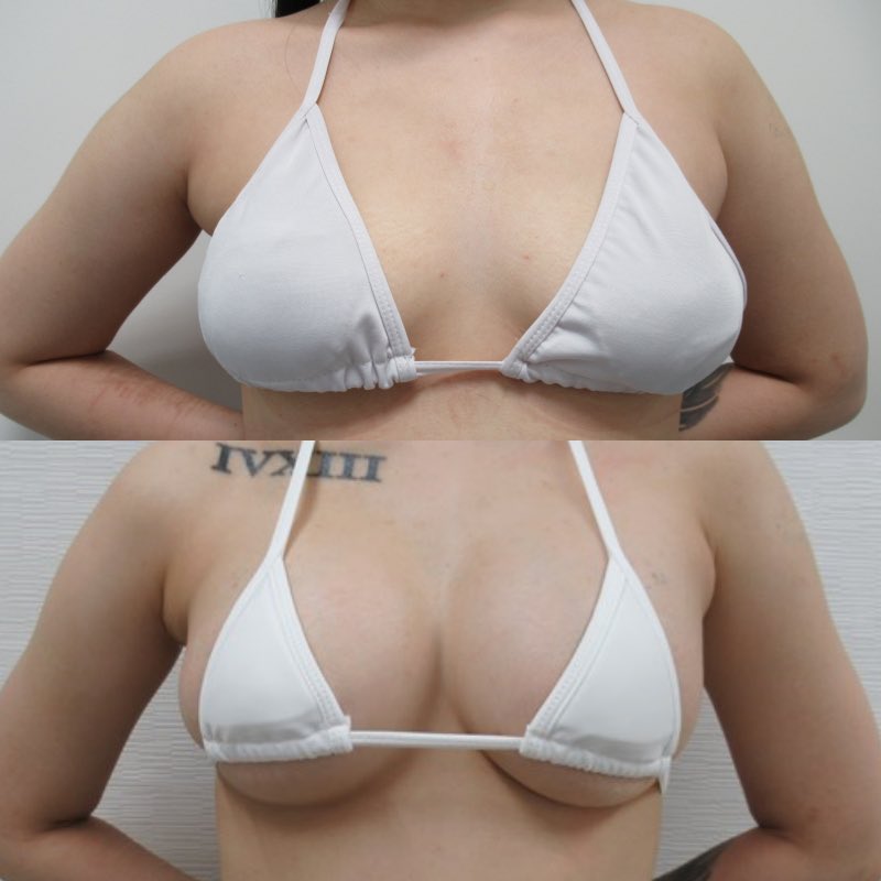 横浜 銀座 新宿 大阪 福岡 高崎 川越taクリニック On Twitter シリコン豊胸術後1か月経過 大胸筋膜下 脇アプローチ Bカップから Eカップまで大きくするならシリコンがおすすめです ヒアルロン酸はただ今1cc 800円でやってます Https T Co Zua4etlrze Twitter