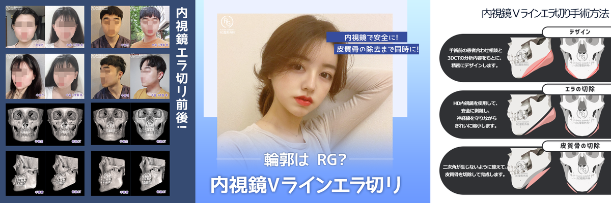 RGplastic's tweet photo. 👑安全ながらも信頼できるRG輪郭専門病院👑
韓国国内患者比率が高い💖RG整形外科🌸

RGならでの長年蓄積されたノーハウで満足できる結果と安全性を最優先にする🌼
🌺RG内視鏡Vラインエラ切り🌺

お問合せ
LINE ID➡️RG_PS

＃顔面輪郭　＃エラ縮小　＃下顎縮小　＃下顎骨整形　＃輪郭有名　＃輪郭専門医 https://t.co/TxbWQfZ5Rb