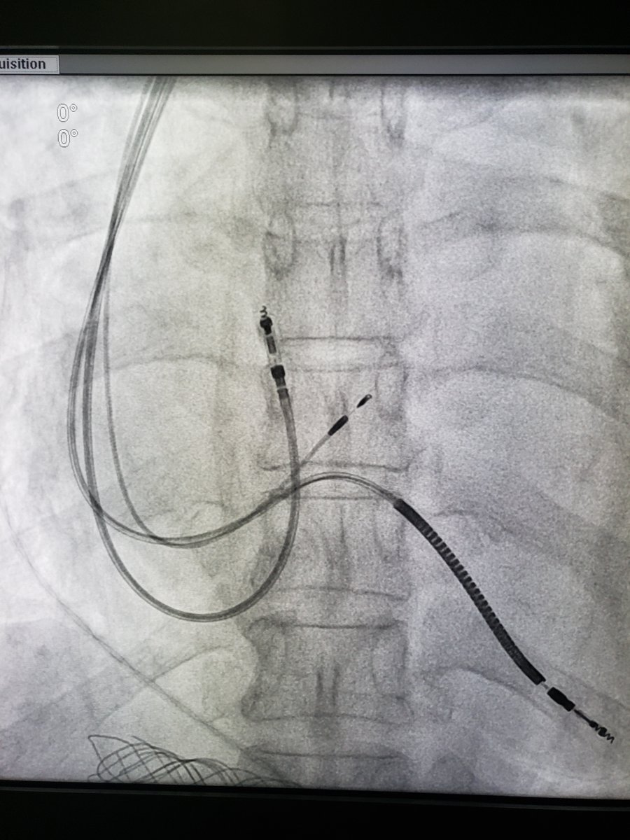 Judson Colley MD, MPH (@j_colley_md) on Twitter photo 58yo F referred for dilated CM, EF<20%, NYHA III CHF, LBBB (QRS 194ms) for CRT-D. Dissected coronary sinus venous ostium on previous attempt for LV lead placement.
#getitdone #EPeeps <a href="/JacksonHeartMS/">Jackson Heart Clinic</a>
Thanks for your work in the field! <a href="/MdHuang/">Weijian Huang</a> <a href="/psharmadoc/">Parikshit S Sharma, MD, MPH, FACC, FHRS</a> <a href="/seth_j_worley/">Seth J Worley MD</a> <a href="/Hisdoc1/">Pugal Vijayaraman</a> 58yo F referred for dilated CM, EF<20%, NYHA III CHF, LBBB (QRS 194ms) for CRT-D. Dissected coronary sinus venous ostium on previous attempt for LV lead placement.
#getitdone #EPeeps <a href="/JacksonHeartMS/">Jackson Heart Clinic</a>
Thanks for your work in the field! <a href="/MdHuang/">Weijian Huang</a> <a href="/psharmadoc/">Parikshit S Sharma, MD, MPH, FACC, FHRS</a> <a href="/seth_j_worley/">Seth J Worley MD</a> <a href="/Hisdoc1/">Pugal Vijayaraman</a>