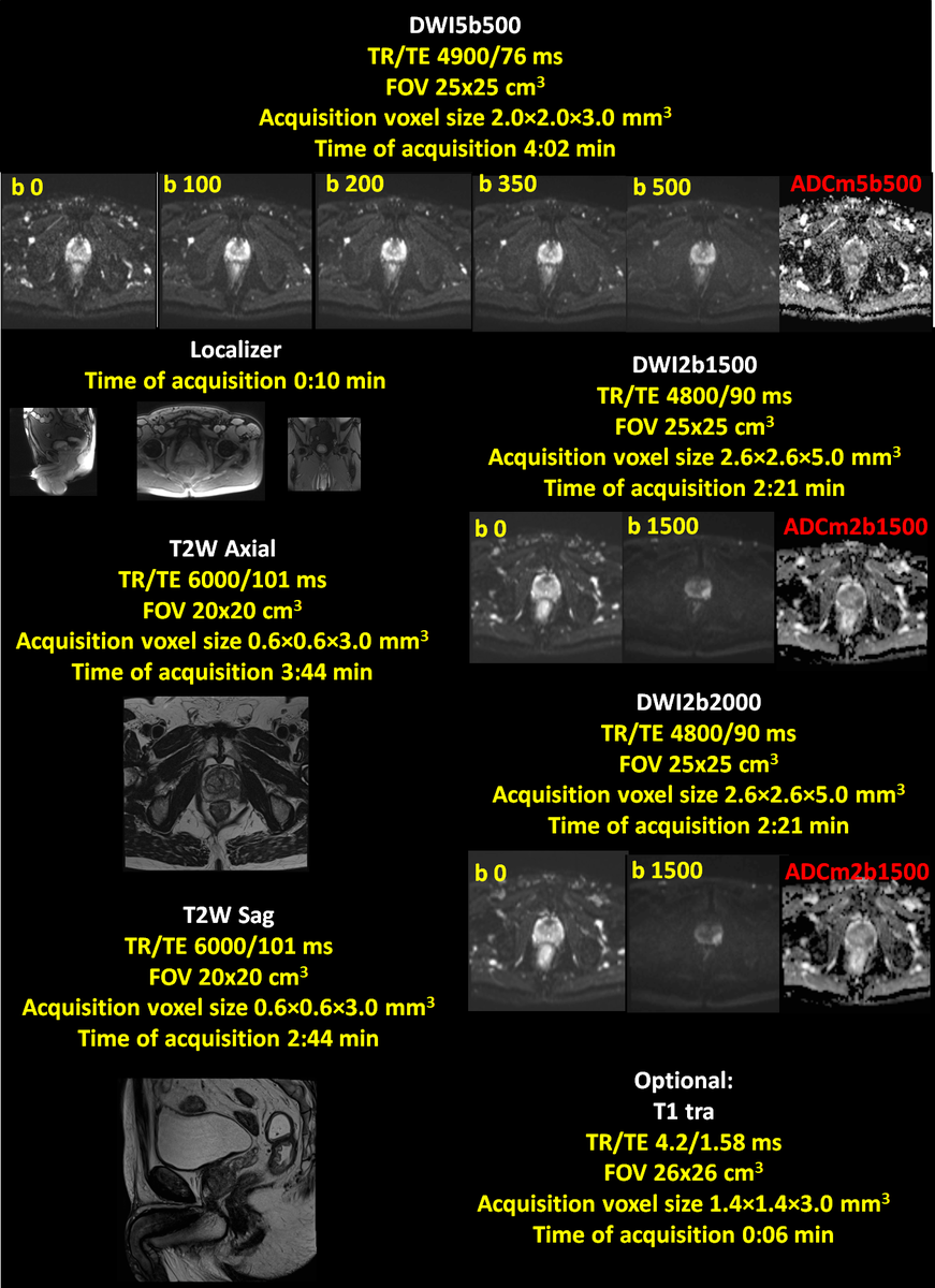 jambor_ivan's tweet photo. #prostateMRItips #tip20 Prostate MRI acquisition protocol for 1.5T #Siemens (Avanto, Aera, Amira, Aera, Altea) MRI scanners #Multi_IMPROD case no. 285 https://t.co/XQEUDOaT9k https://t.co/Ta5Ah5oKBU