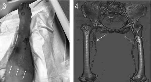 VMJ_SVM's tweet image. Images in Vascular Medicine: Peripheral artery thrombosis in critically ill patients with #COVID19
ow.ly/BwbE50AOMDA