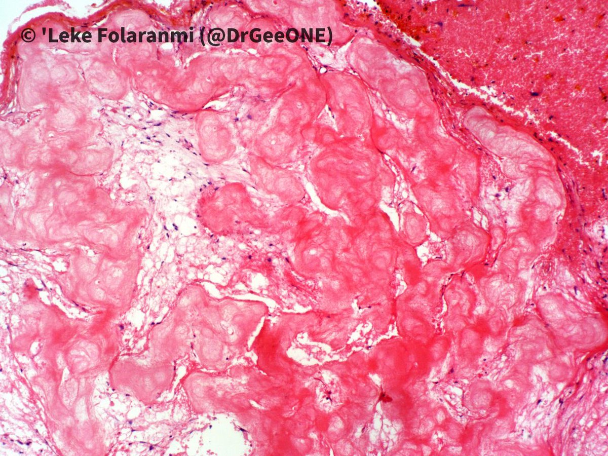 DrGeeONE's tweet photo. A young Male with (pathological) fracture of the proximal femur

🔅Histology shows modules of eosinophilic “cementum-like” material with scant loose fibrovascular stroma. 

🔆🔼: Simple (Solitary) Bone cyst 

@Mattzaborowski1 @Rosapath @DrFNA have shared cases in the past https://t.co/YdZphS5IFK