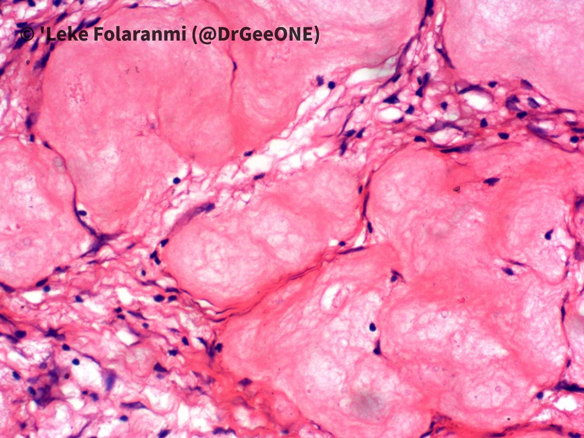DrGeeONE's tweet photo. A young Male with (pathological) fracture of the proximal femur

🔅Histology shows modules of eosinophilic “cementum-like” material with scant loose fibrovascular stroma. 

🔆🔼: Simple (Solitary) Bone cyst 

@Mattzaborowski1 @Rosapath @DrFNA have shared cases in the past https://t.co/YdZphS5IFK