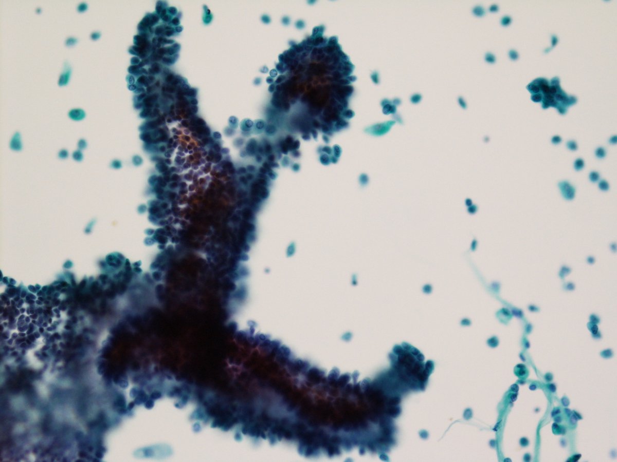 jfhang's tweet photo. [Case of the day] 76 y/o female, left renal pelvis washing cytology (SurePath &amp; Cytospin) and biopsy #TheParisSystem #cytopath @cjvand @PoonamVohra3 @MLisaZhang @YurinaMiki @PatMcIntireMD https://t.co/0p5VPwpt5y