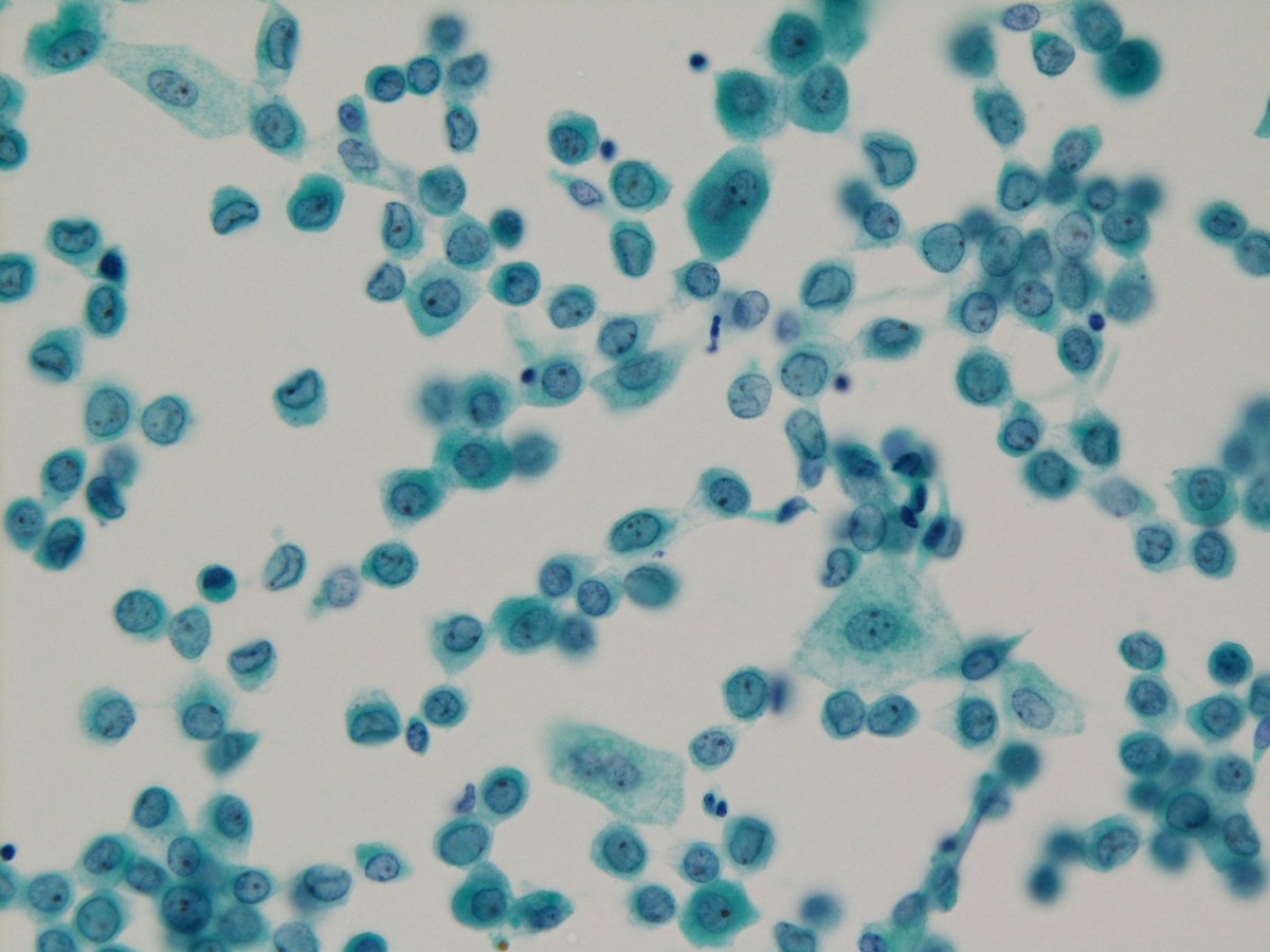 jfhang's tweet photo. [Case of the day] 76 y/o female, left renal pelvis washing cytology (SurePath &amp; Cytospin) and biopsy #TheParisSystem #cytopath @cjvand @PoonamVohra3 @MLisaZhang @YurinaMiki @PatMcIntireMD https://t.co/0p5VPwpt5y