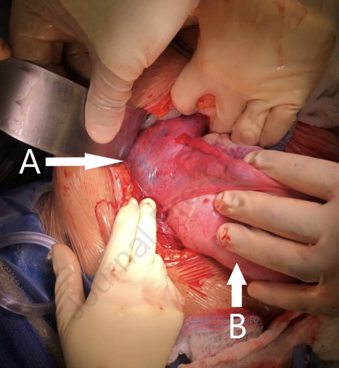 AJOG_thegray's tweet photo. Images in Obstetrics:  Perforation with #Bakri Balloon Into Broad Ligament During Management of #Postpartum #Hemorrhage https://t.co/C04JatubxV #obgyn #pregnancy https://t.co/ziTjagAR4t