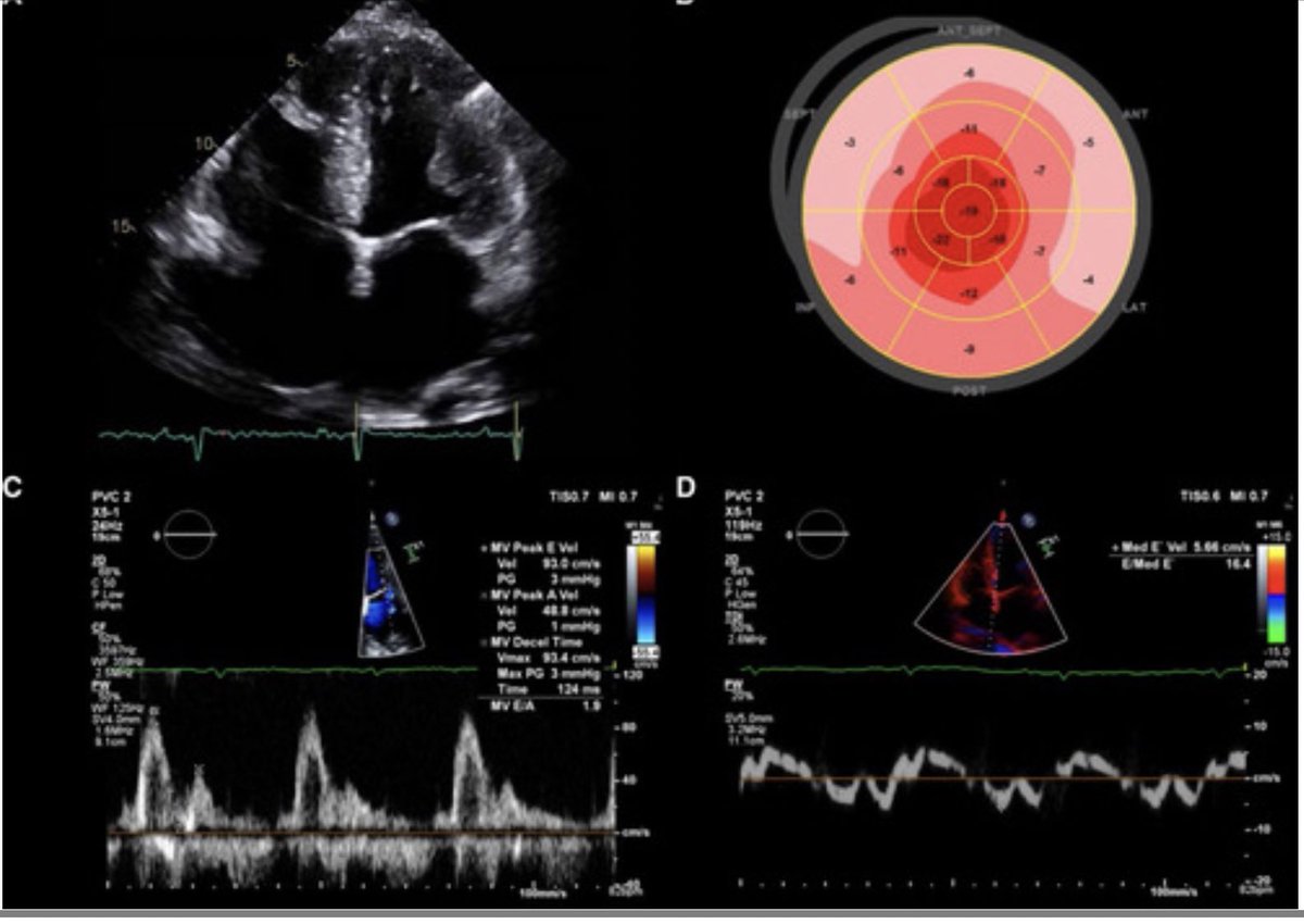 hvanspall's tweet photo. A comprehensive case-based review of the diagnostic workup of #CardiacAmyloid in @Circ_AHA 
https://t.co/fUxVAs3Ts0 
#ATTR #AL #Amyloidosis @DrClaudiusMahr @HeartOTXHeartMD @DrRajivsankar https://t.co/zrOFWhrxZd
